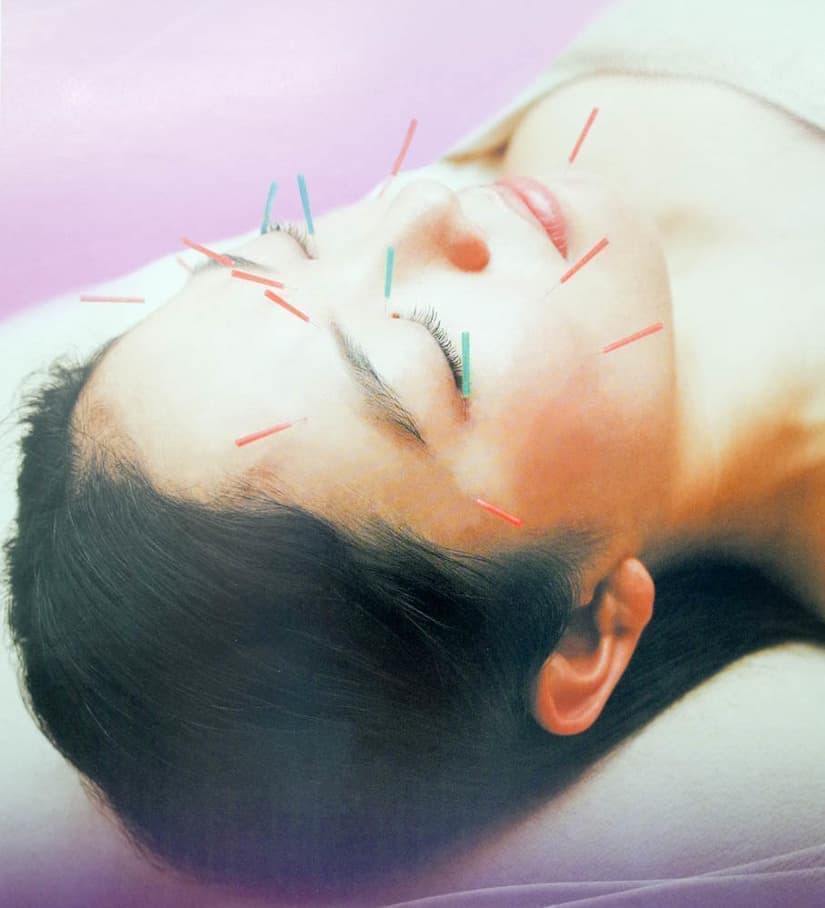 美容鍼